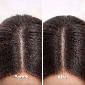 Ready to Ship Ketoconazole Anti-Dandruff Shampoo – Medicated 2% Formula for Seborrheic Dermatitis, Targeted Relief from Scalp Flaking, Itching & Fungal Overgrowth, Clinically Proven Dandruff Treatment